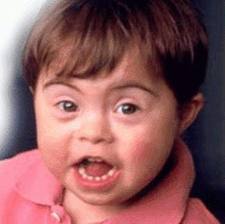 down sendromu-ba.jpg